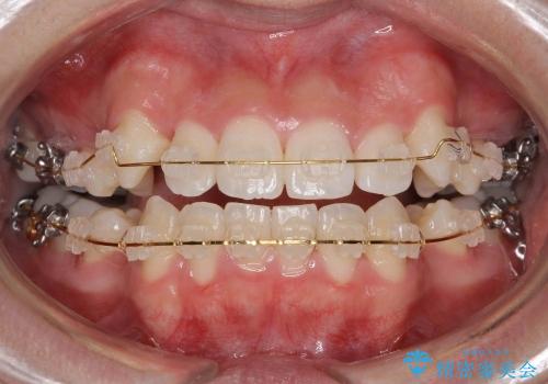 10代女性　八重歯　前歯のガタガタの治療中