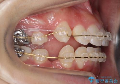 10代女性　八重歯　前歯のガタガタの治療中