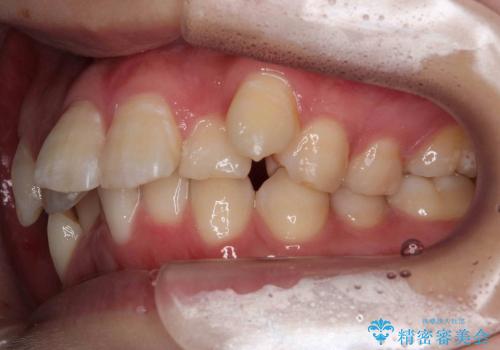 10代女性　前歯のでこぼこ　奥歯が埋まって生えてこないの治療前