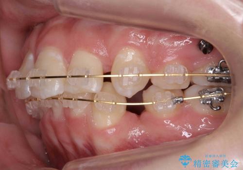 10代女性　前歯のでこぼこ　奥歯が埋まって生えてこないの治療中