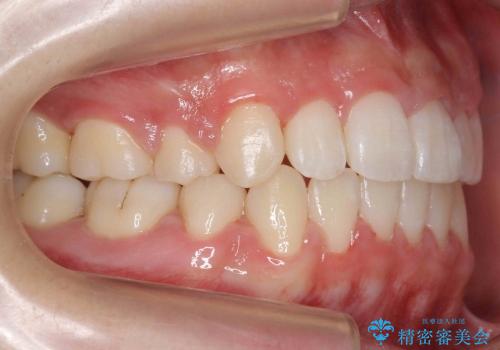 10代女性　八重歯　前歯のガタガタの治療後