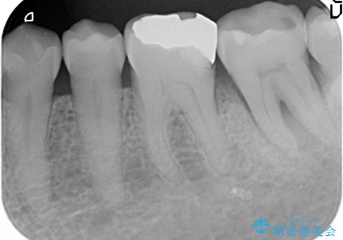 咬む力が強すぎて抜歯に　歯の移植による治療の症例 治療前