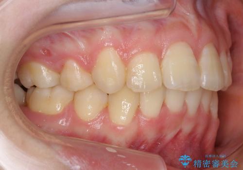 10代女性　前歯のでこぼこ　奥歯が埋まって生えてこないの治療後
