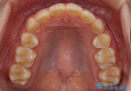 10代女性　前歯のでこぼこ　奥歯が埋まって生えてこないの治療後