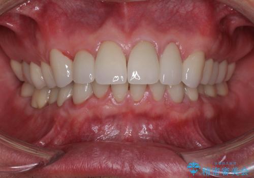 40代男性　銀歯を白く　虫歯だらけの歯を治したいの症例 治療後