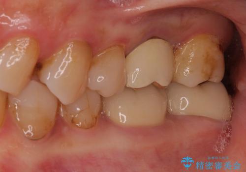 咬む力が強すぎて抜歯に　歯の移植による治療の治療後