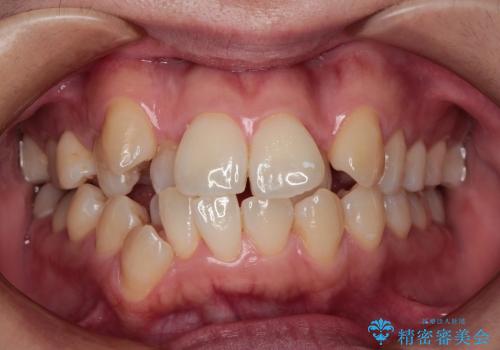 30代女性　でこぼこの前歯をきれいに　抜歯矯正　審美装置の治療前