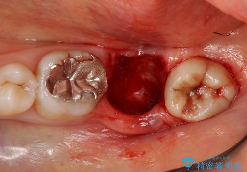 咬む力が強すぎて抜歯に　歯の移植による治療の治療中