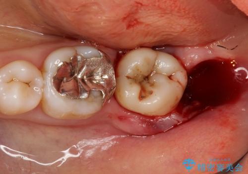 咬む力が強すぎて抜歯に　歯の移植による治療の治療中