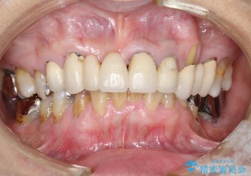 歯茎再生とセラミック治療の症例 治療前