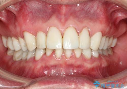 40代男性　銀歯を白く　虫歯だらけの歯を治したいの治療中
