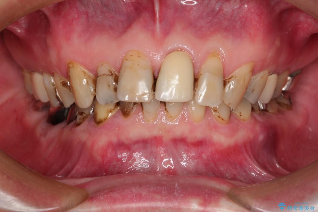 さ*さ様 銀歯 銀歯をセラミックに変えられる？歯の詰め物のポイントと注意点