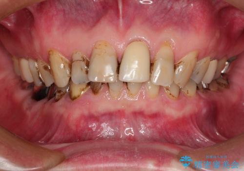 40代男性　銀歯を白く　虫歯だらけの歯を治したいの症例 治療前