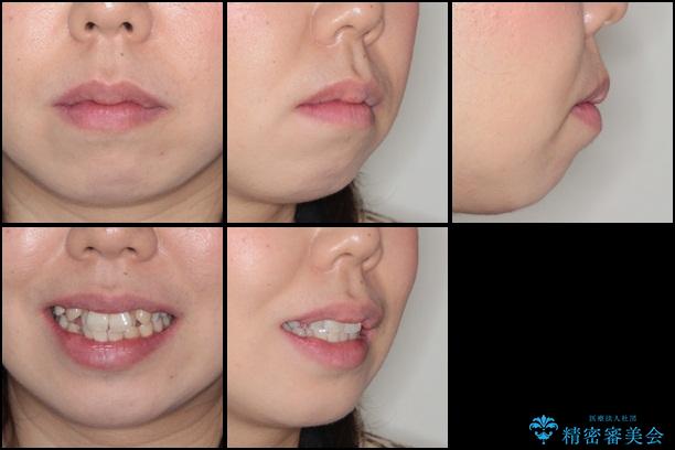 30代女性　でこぼこの前歯をきれいに　抜歯矯正　審美装置の治療前（顔貌）