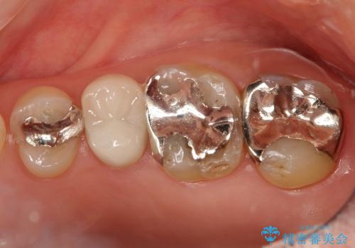 銀歯を外すと、中には虫歯・・・奥歯のセラミック治療の治療前