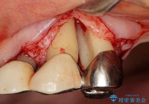 重度歯周病　再生治療による歯の保存の治療前