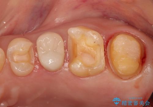 銀歯を外すと、中には虫歯・・・奥歯のセラミック治療の治療中