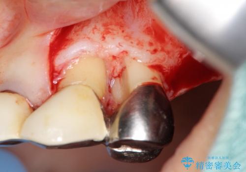重度歯周病　再生治療による歯の保存の治療後