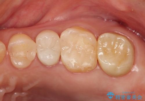 銀歯を外すと、中には虫歯・・・奥歯のセラミック治療の治療後
