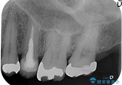 銀歯を外すと、中には虫歯・・・奥歯のセラミック治療の治療前