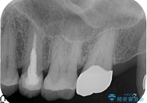 銀歯を外すと、中には虫歯・・・奥歯のセラミック治療の治療後