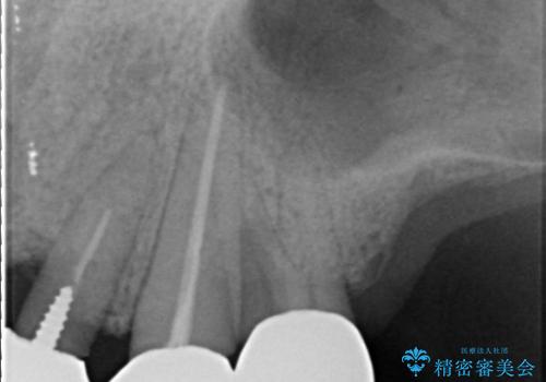 重度歯周病　再生治療による歯の保存の治療前