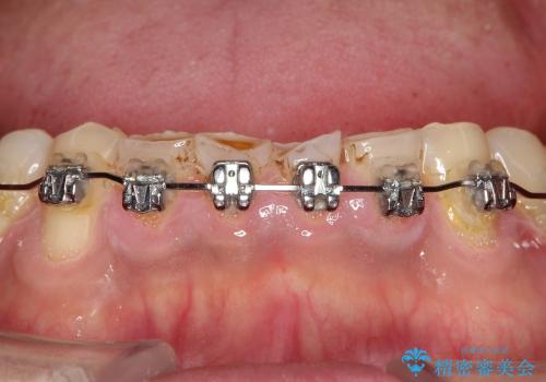 擦り減った前歯の回復(矯正との連携)の治療前