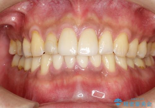 擦り減った前歯の回復(矯正との連携)の治療後