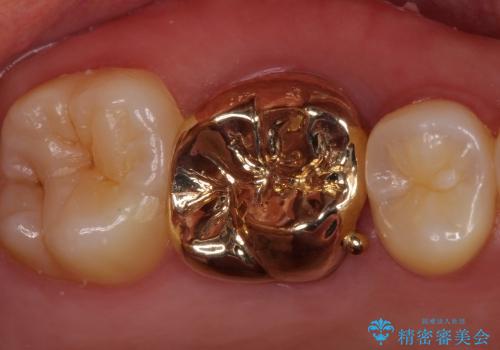 20代女性　ゴールドクラウンによる虫歯治療