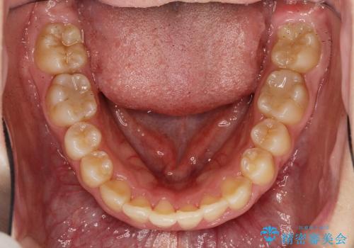 20代女性　前歯のでこぼこ・咬み合わせの治療後
