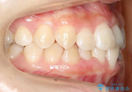 20代女性　前歯のでこぼこ・咬み合わせの治療前