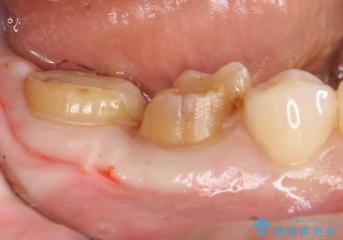 20代女性　歯の長さを改善して被せものをの治療前