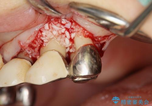 重度歯周病　再生治療による歯の保存の治療中