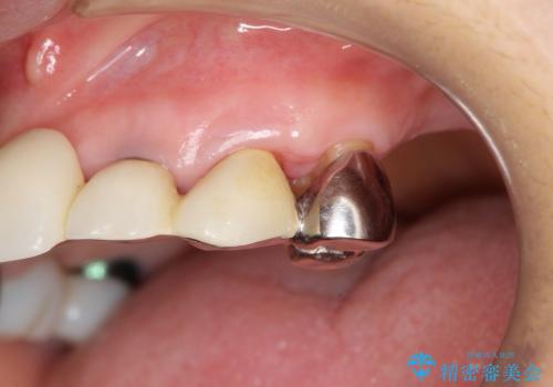重度歯周病　再生治療による歯の保存の治療後