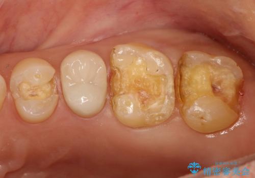 銀歯を外すと、中には虫歯・・・奥歯のセラミック治療の治療中