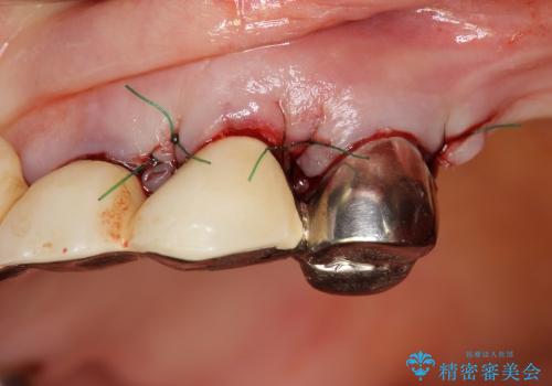 重度歯周病　再生治療による歯の保存の治療中