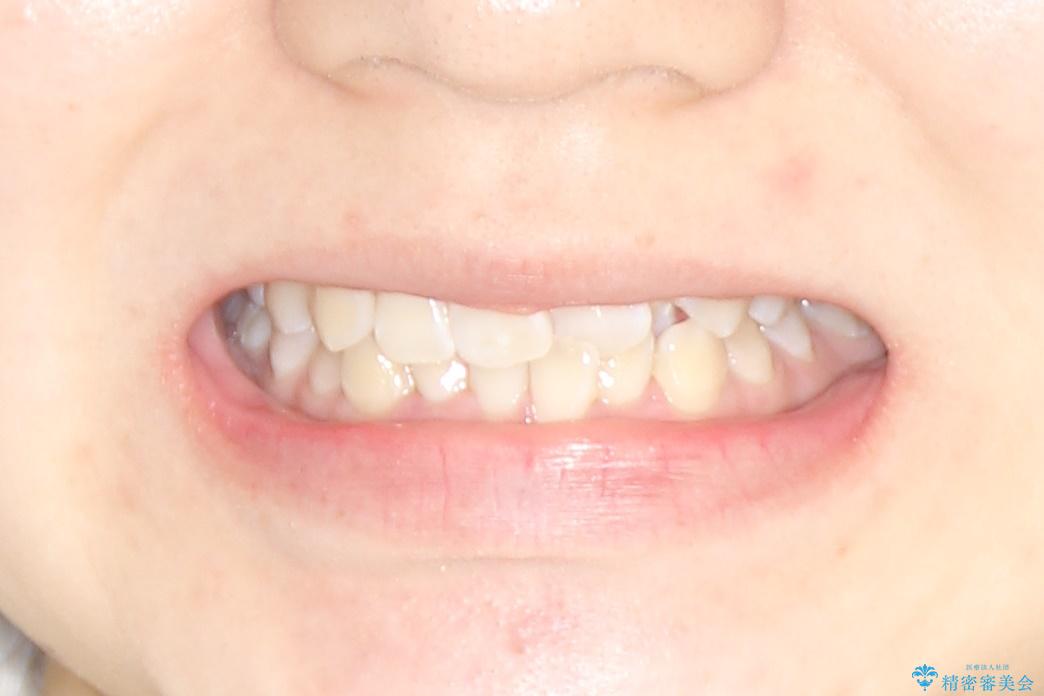 20代女性　前歯のでこぼこ・咬み合わせの治療前（顔貌）