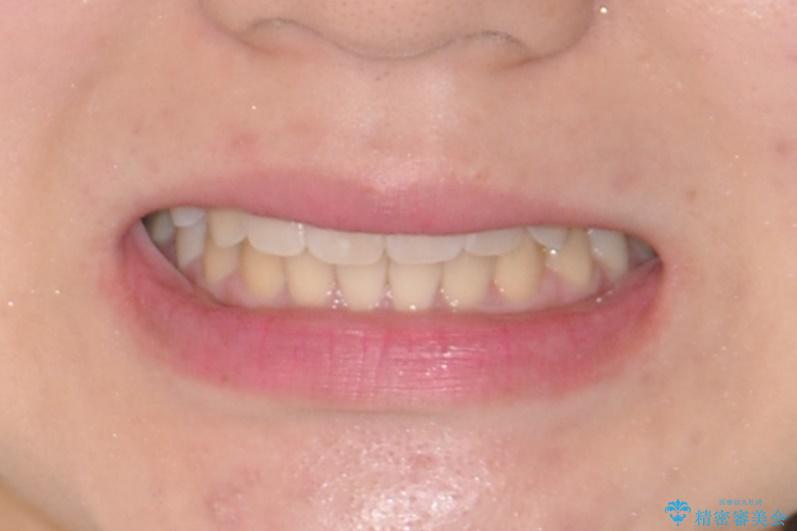 20代女性　前歯のでこぼこ・咬み合わせの治療後（顔貌）