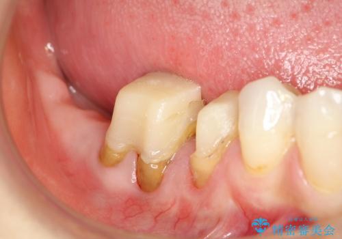 深い虫歯 歯を残す治療の治療中