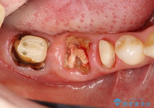 深い虫歯 歯を残す治療の治療前