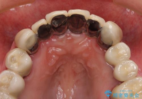 重度歯周病・深い虫歯　歯を残す治療の治療後