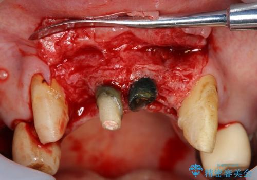 重度歯周病・深い虫歯　歯を残す治療