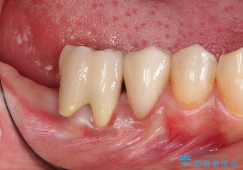 深い虫歯 歯を残す治療の症例 治療後
