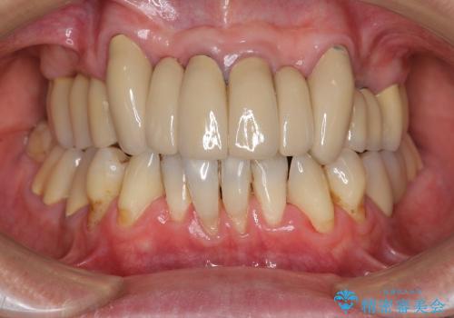 重度歯周病・深い虫歯　歯を残す治療の治療後
