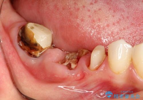 深い虫歯 歯を残す治療の症例 治療前