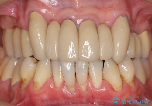 重度歯周病・深い虫歯　歯を残す治療の症例 治療後