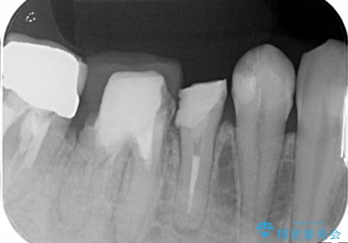 深い虫歯 歯を残す治療の治療前