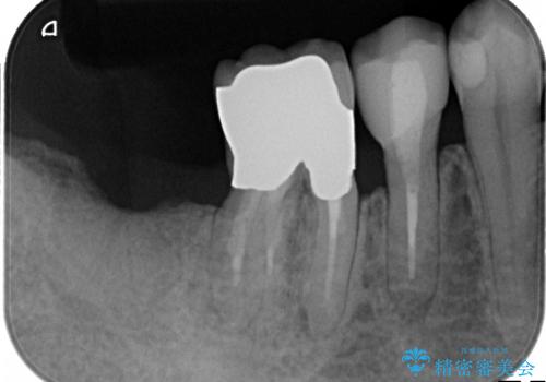 深い虫歯 歯を残す治療の治療後