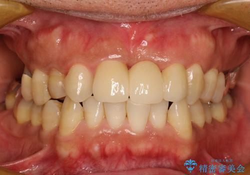 40代男性　歯ぐきの厚みを増やしてブリッジの症例 治療後