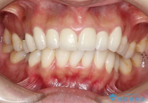 セラミック(前歯)のやり変えの症例 治療後